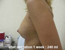 plastic-surgery-breast-augmentation 